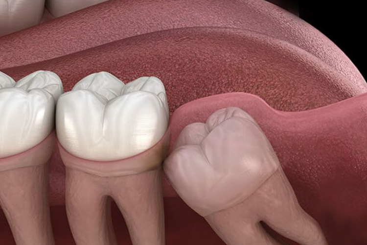 Wisdom Tooth Anatomy